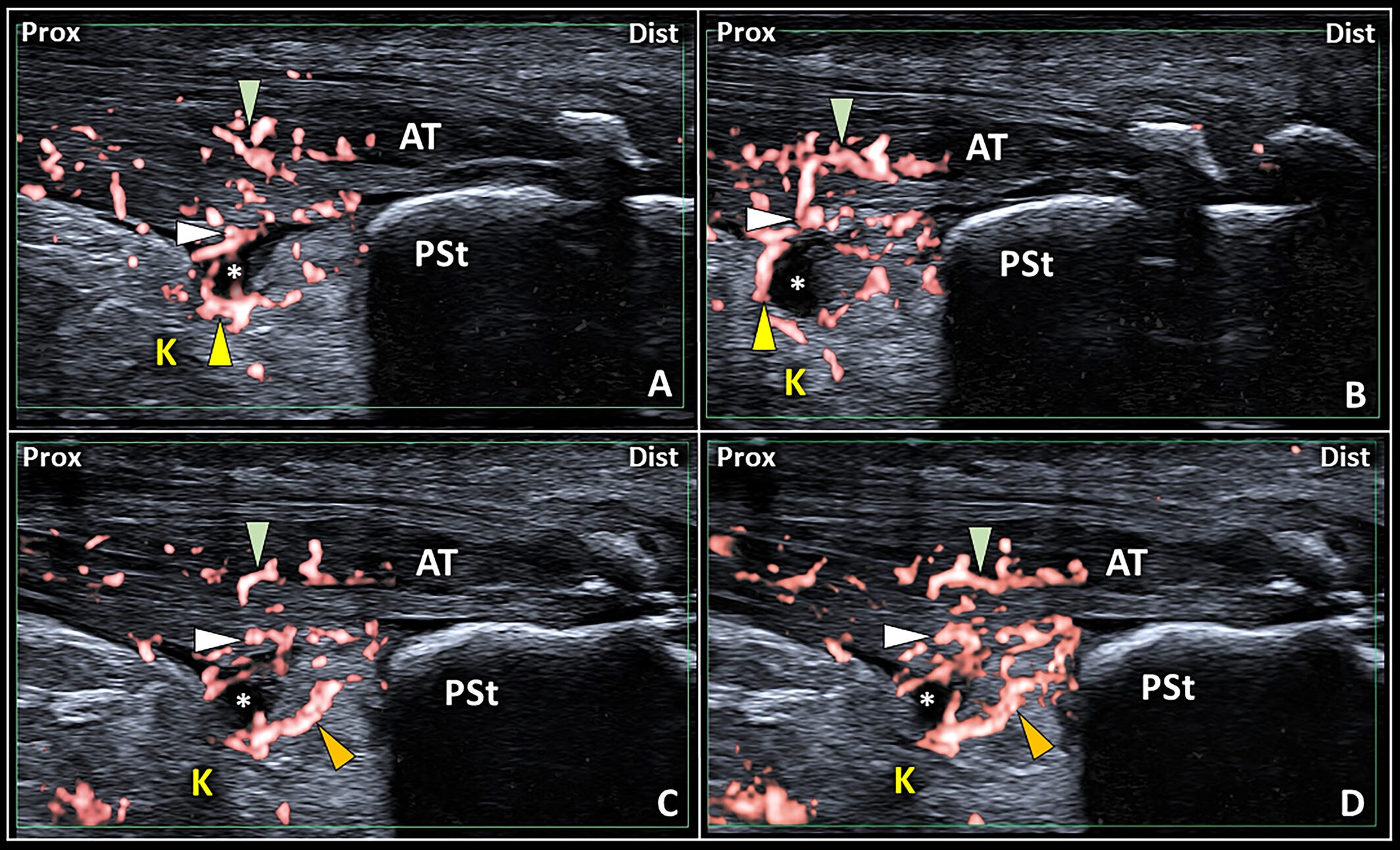 Bursa retrocalcanea 8 Tempo Formacion ecografia.jpg